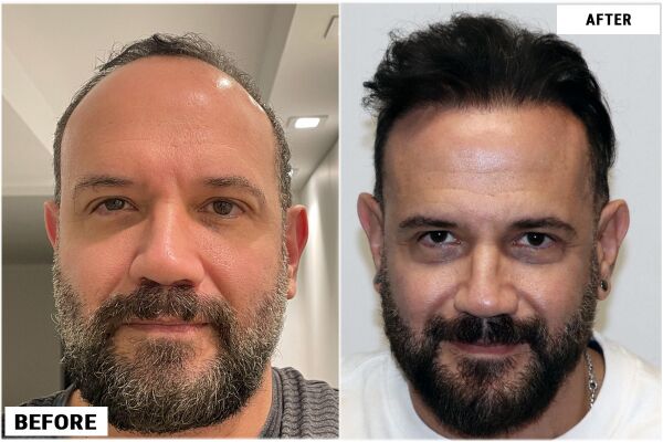 ForHair Clinic - Before and After Hair Restoration