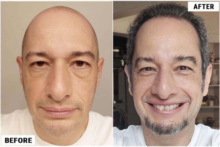 ForHair Clinic - Before and After Hair Restoration