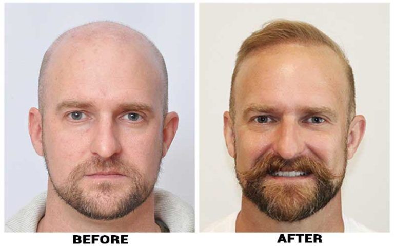 ForHair Clinic - Before and After Hair Restoration