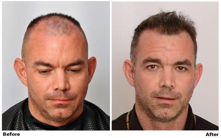ForHair Clinic - Before and After Hair Restoration