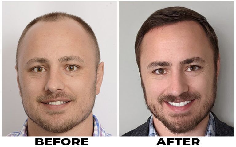ForHair Clinic - Before and After Hair Restoration