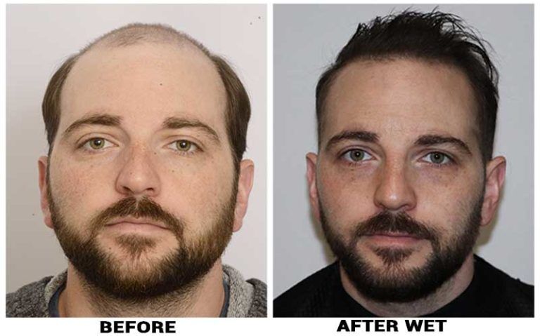 ForHair Clinic - Before and After Hair Restoration